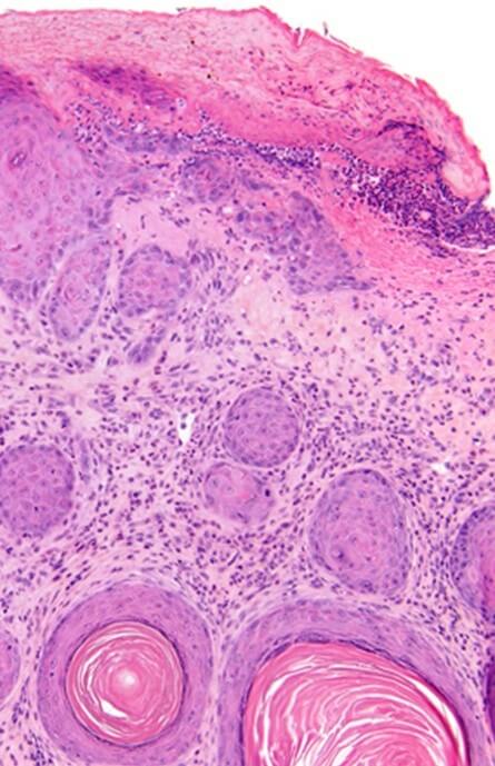 This image depicts a deeper biopsy revels that this lesion contains reactive squamous proliferation. Professional medical imaging for clinical reference and educational purposes. [umbracoNodeId=18663]