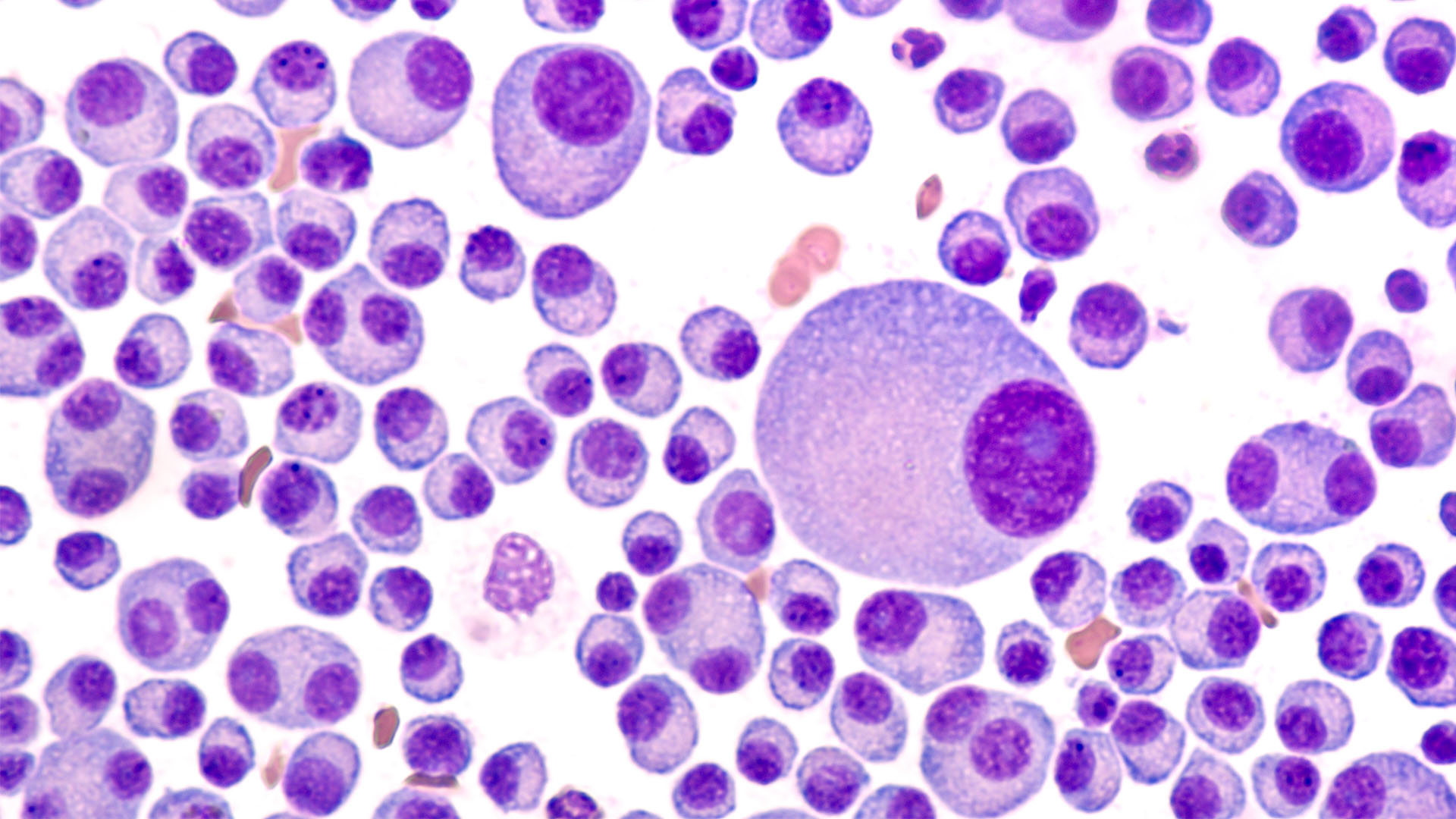 Dec 2023 - Multiple myeloma
