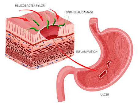 Figure 1. Gastric ulcer caused by H.pylori infection - September 2025