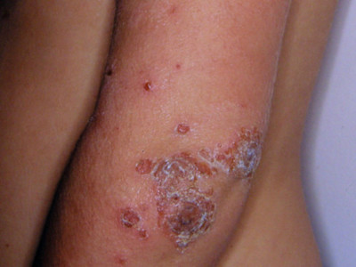 Figure 1 - impetigo skin infection - strep A children - December 2023