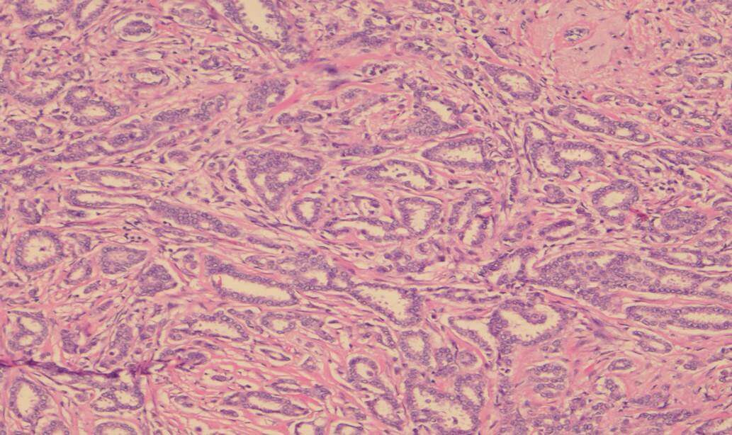 This image depicts grade 1 invasive carcinoma. Professional medical imaging for clinical reference and educational purposes. [umbracoNodeId=9796]