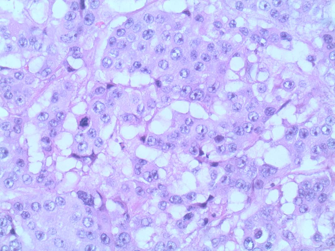 This image depicts grade 3 invasive carcinoma. Professional medical imaging for clinical reference and educational purposes. [umbracoNodeId=9798]