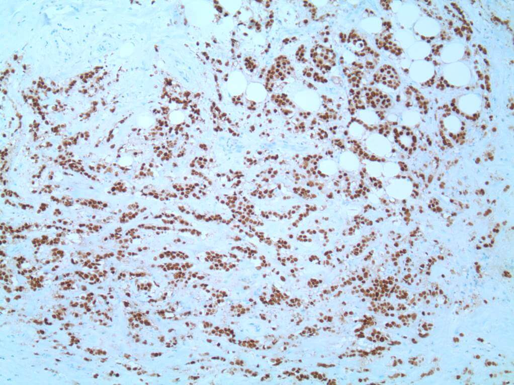 This image depicts grade 3 invasive carcinoma. Professional medical imaging for clinical reference and educational purposes. [umbracoNodeId=9801]