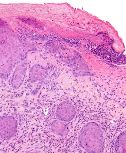 This image depicts is this lesion benign (reactive squamous hyperplasia) or it it a well differentiated squamous cell carcinoma?. Professional medical imaging for clinical reference and educational purposes. [umbracoNodeId=18662]
