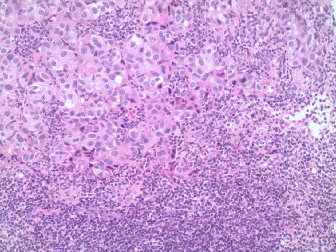 This image depicts metastatic carcinoma in a lymph node. Professional medical imaging for clinical reference and educational purposes. [umbracoNodeId=9800]